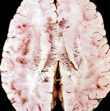 Sốt rét thể não (Cerebral Malaria)