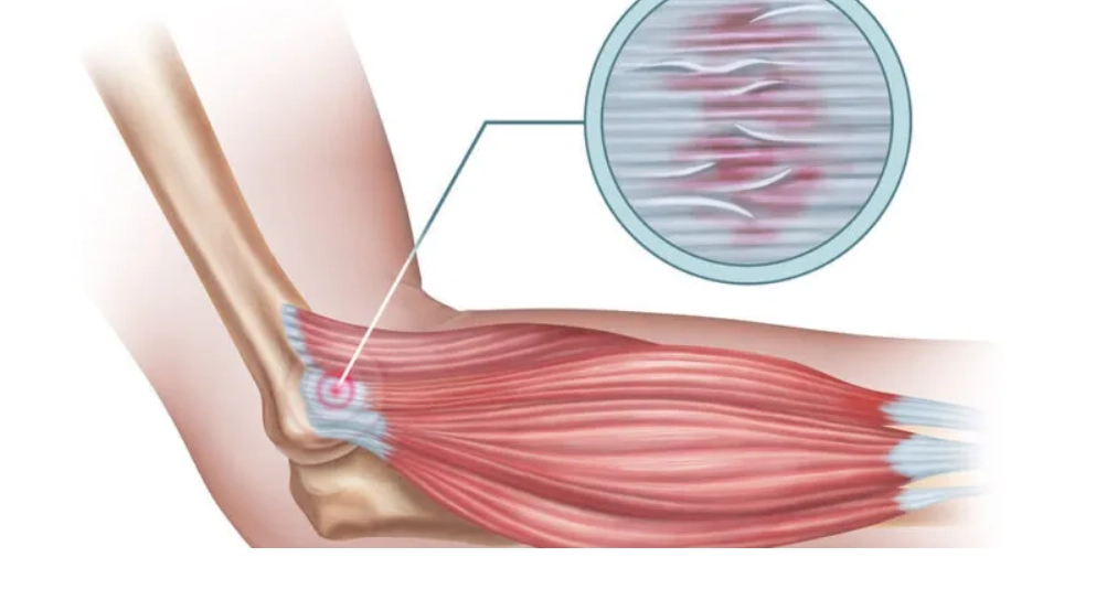 Khuỷu tay và cẳng tay (Elbow &amp; Forearm )