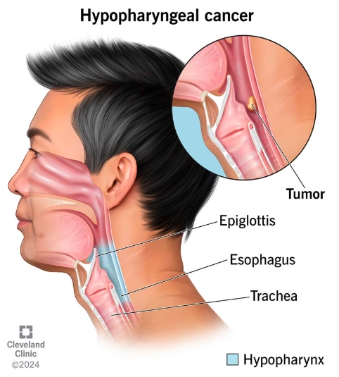 Phân giai đoạn ung thư biểu mô hạ hầu (Hypopharyngeal carcinoma (staging))