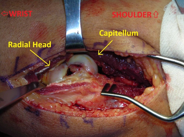 Gãy chỏm con xương cánh tay (Capitellum fracture)