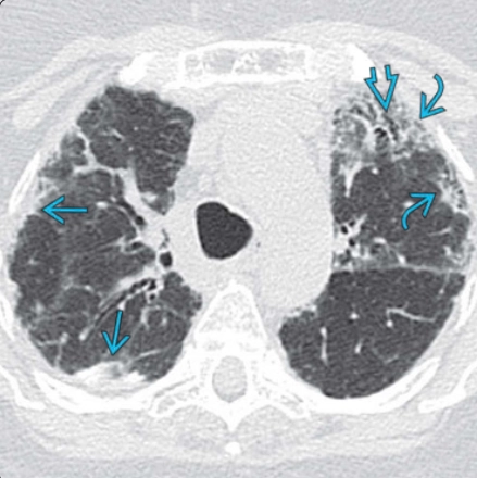 Tăng sinh sợi đàn hồi màng phổi-phổi (Pleuroparenchymal fibroelastosis - PPFE)