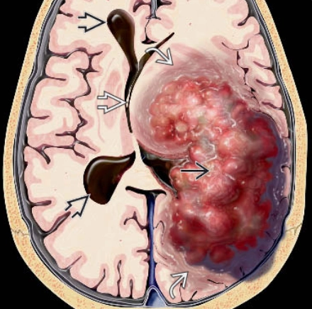 Ung thư biểu mô đám rối mạch mạc (Choroid Plexus Carcinoma) 