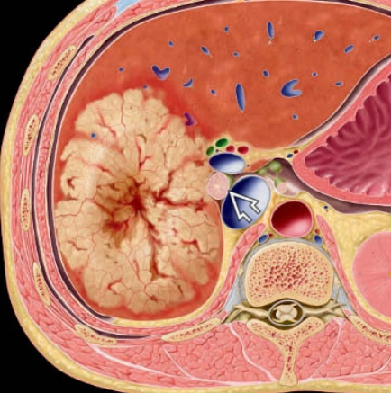 Ung thư biểu mô tế bào gan dạng sợi (Fibrolamellar Hepatocellular Carcinoma - FL-HCC)