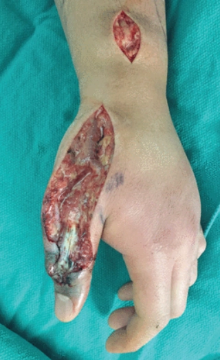 Viêm cân mạc hoại tử (Necrotizing fasciitis)