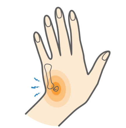 Gãy xương móc (Hamate fracture)