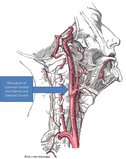 Hội chứng đau động mạch cảnh (Carotidynia)