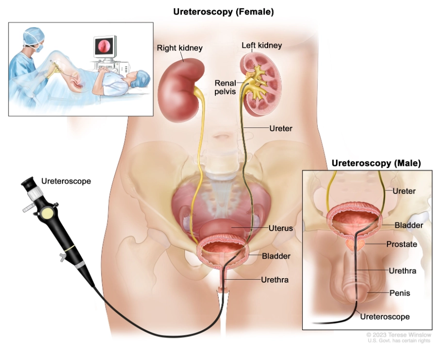 Ung thư biểu mô tế bào chuyển tiếp niệu quản (Transitional cell carcinoma of ureter- TCC)