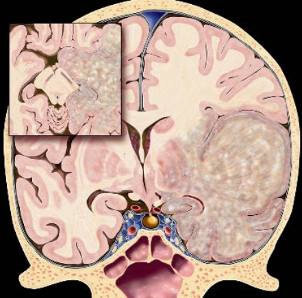 U sao bào lan tỏa (Diffuse Astrocytoma)