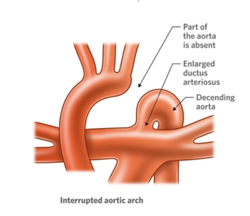 Gián đoạn cung động mạch chủ