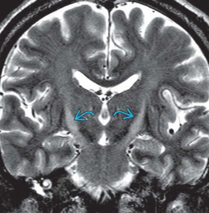 Bệnh xơ cứng teo cơ một bên (Amyotrophic lateral sclerosis - ALS)