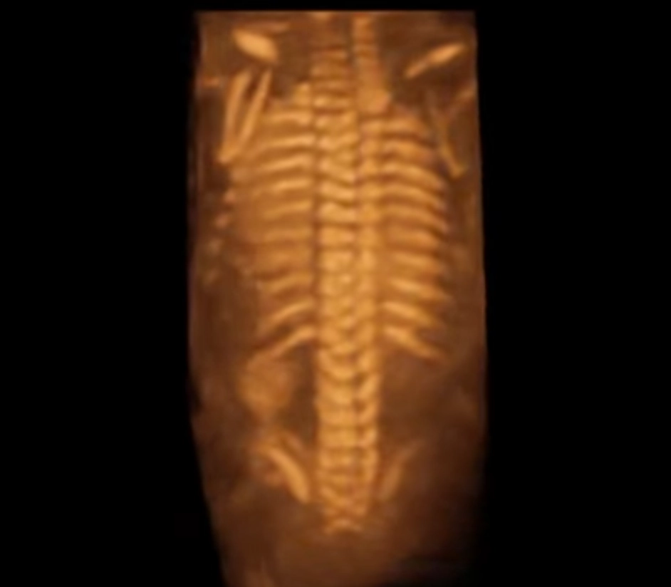 Giải phẫu cột sống thai nhi