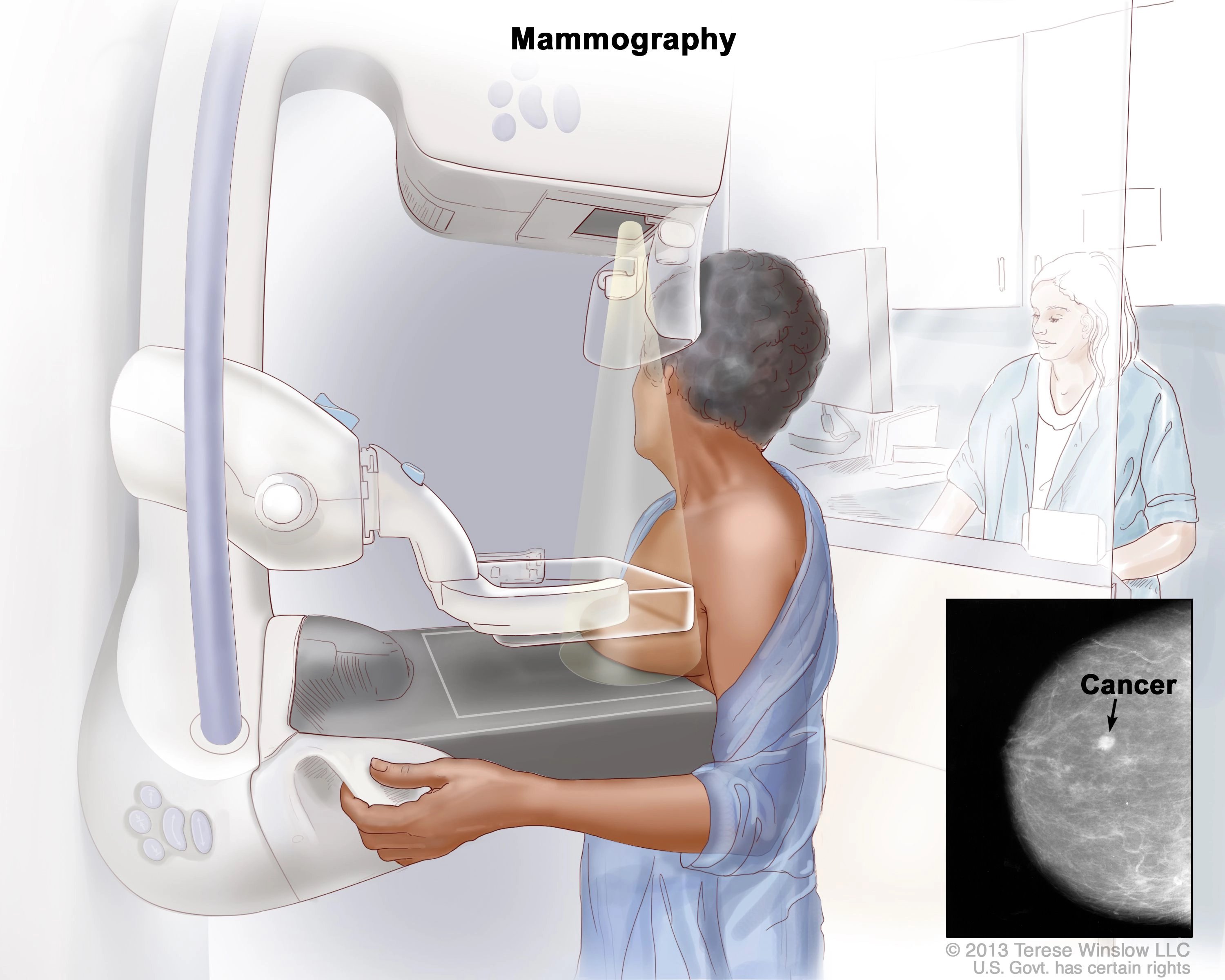 Nhũ ảnh (Mammography)