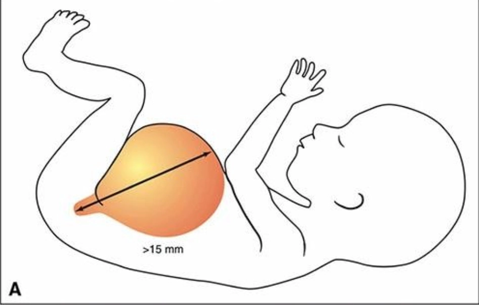 Bàng quang to (Megacystis) và tắc nghẽn đường tiết niệu dưới (Lower urinary tract obstruction)