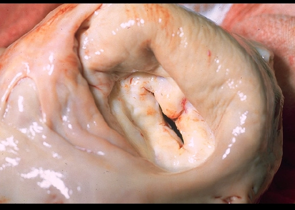 Vôi hóa vòng van hai lá (Mitral annular calcification)