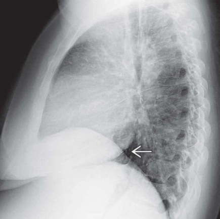 Hội chứng đồng dạng (Heterotaxy syndrome)