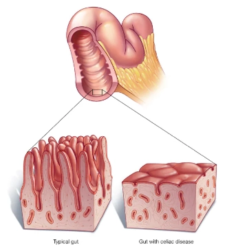 Bệnh Celiac (Celiac disease)