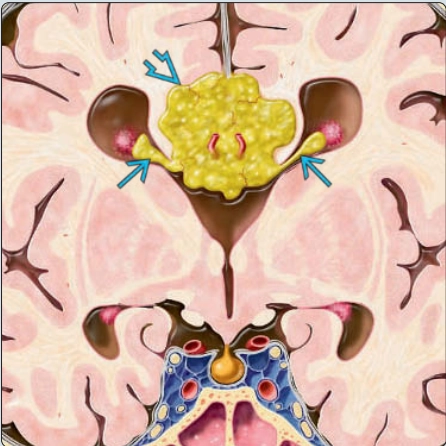 U mỡ nội sọ thai nhi (Intracranial Lipoma)