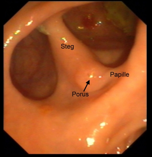Túi thừa tá tràng (Duodenal Diverticulum)