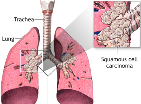 Ung thư biểu mô tế bào vảy khí quản (Tracheal squamous cell carcinoma - SCC)
