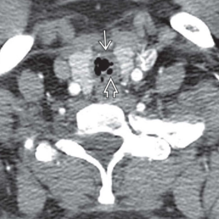 Bệnh xơ cứng mũi (Rhinoscleroma)