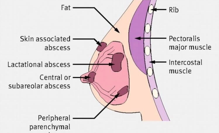 Áp xe vú (Breast abscess)