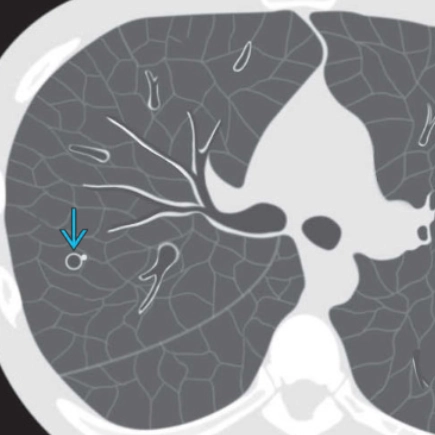 Dấu hiệu nhẫn kim cương (giãn phế quản )/Signet ring sign (bronchiectasis)