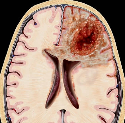 U nguyên bào thần kinh đệm (Glioblastoma- GBM)