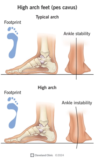 Bàn chân vòm cao (Pes cavus)
