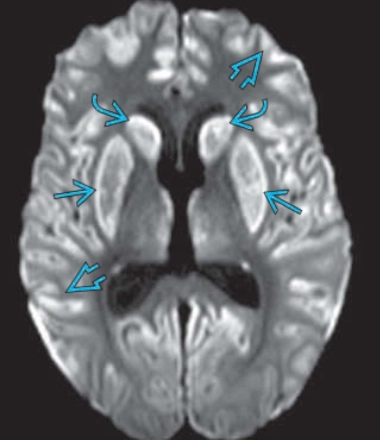 Ngộ độc Cyanide (Cyanide Poisoning)