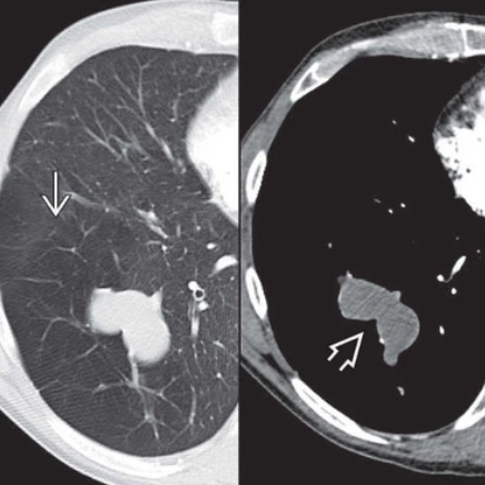 Bất sản phế quản (Bronchial atresia - BA)