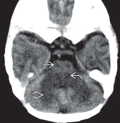 Bệnh nước tiểu mùi si-rô phong (Maple syrup urine disease - MSUD)  