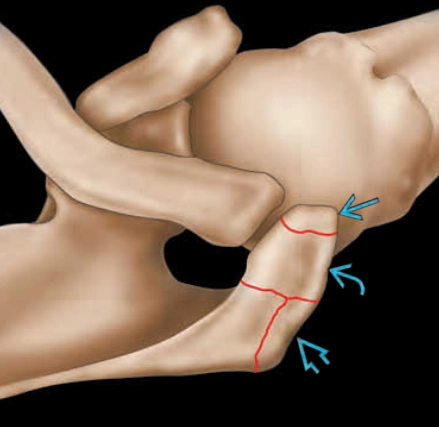 Mỏm cùng vai phụ (Os acromiale)