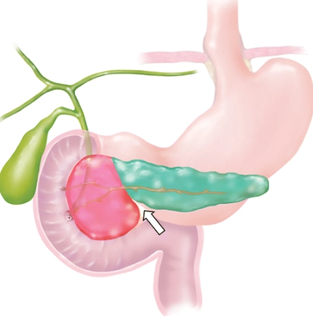 Chấn thương tụy (Pancreatic Trauma)