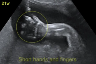 Loạn sản sụn ở trẻ em (Achondroplasia)