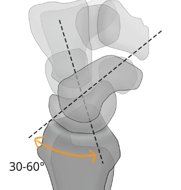 Góc Thuyền-Nguyệt (Scapholunate angle)