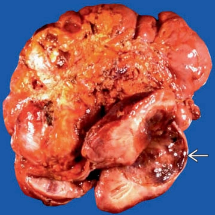 U Desmoid mạc treo (Mesenteric desmoid tumor)
