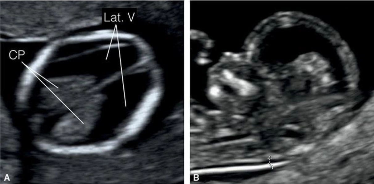 Dãn não thất (Ventriculomegaly)
