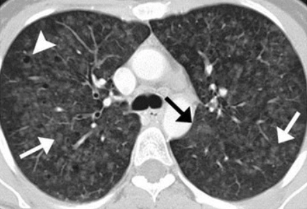 Bệnh phổi kẽ liên quan đến viêm tiểu phế quản hô hấp (Respiratory Bronchiolitis Interstitial Lung Disease - RB-ILD)