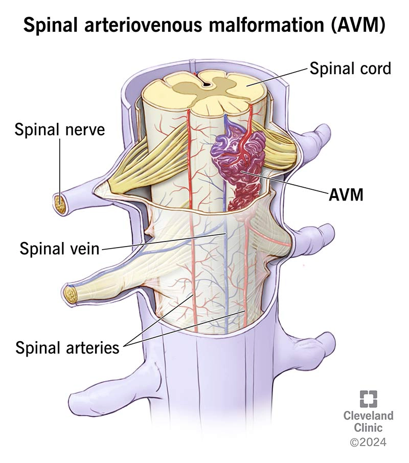 Dị dạng động - tĩnh mạch tủy sống (Spinal Arteriovenous Malformation - AVM)