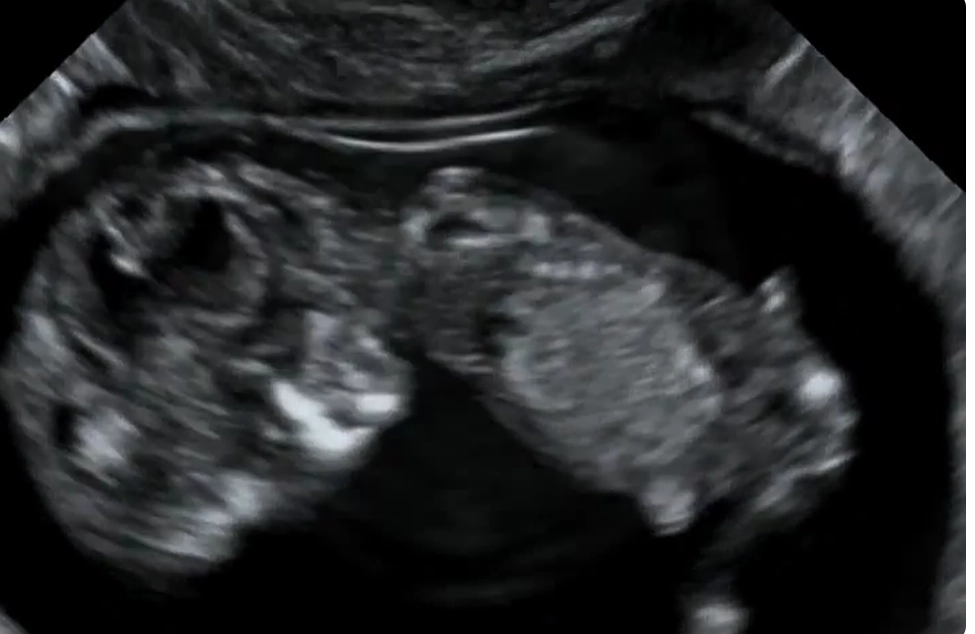 Hội chứng Đa ngón - Xương sườn ngắn (Short Rib-Polydactyly Syndromes - SRPS)