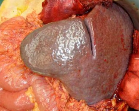 Lách lạc chỗ (Splenosis)