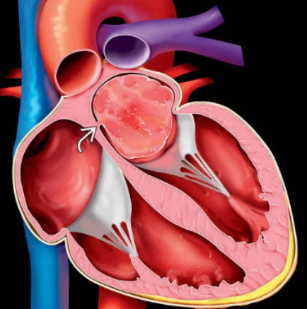 U nhầy tim (Cardiac Myxoma)