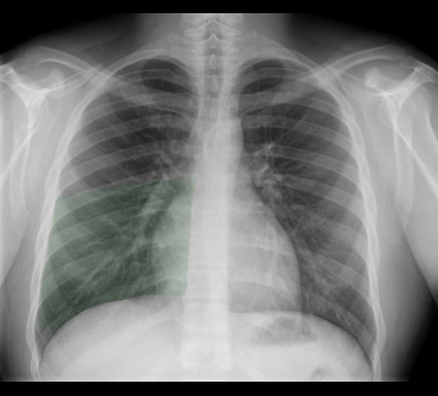 Xẹp thùy giữa phổi phải (Right middle lobe atelectasis)