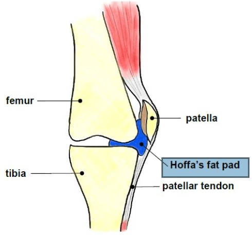 Thoát vị túi mỡ Hoffa (Hoffa fat pad herniation)