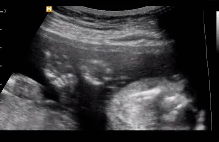 Ngón tay vẹo ở thai (Clinodactyly)