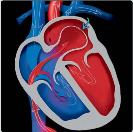 Phình lỗ bầu dục- phình vách liên nhĩ (redundancy of the foramen ovale flap)