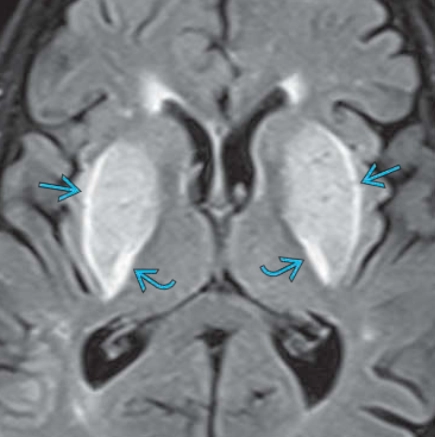 Bệnh não do urê huyết cao (Uremic Encephalopathy)
