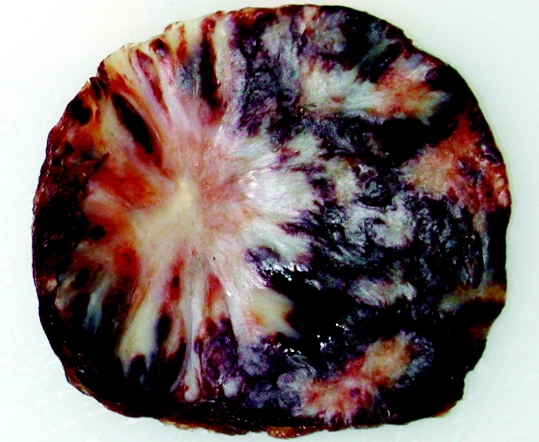 Hamartoma lách (Splenic hamartoma)