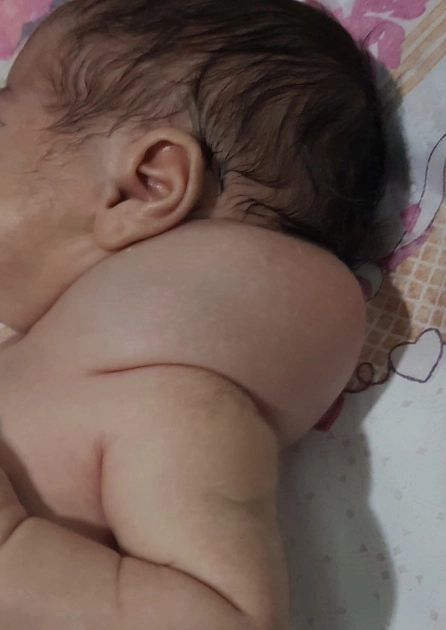 Nang bạch huyết vùng cổ quý I (Cystic hygroma)