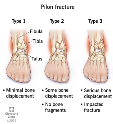 Gãy Pilon (gãy trần xương chày)